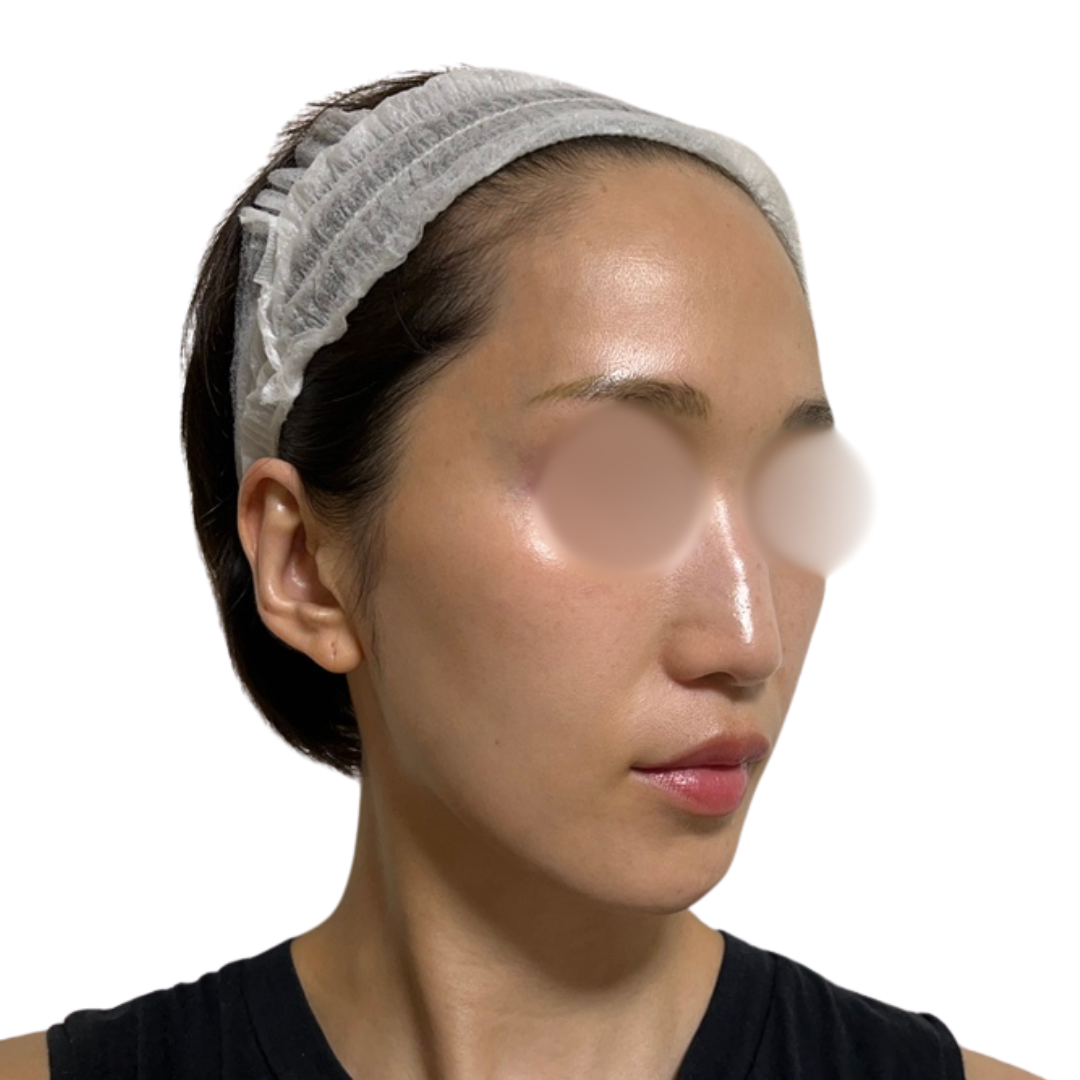 ピコフォーカス（ピコトーニング＋ピコフラクショナル）